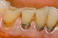 Se invento amalgama dental.