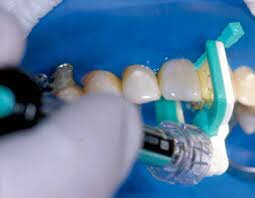 Utilización manual de una resina de baja viscosidad a los haces de fibras.