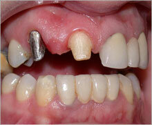 Introducción de las restauraciones de cerámica sin metal procera.