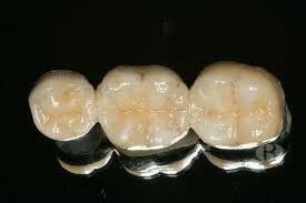 Pfaff, en la construcción de bases de prótesis.