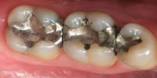 Comienza el uso de la amalgama