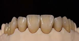 Cerámica moldeable (Dicor)