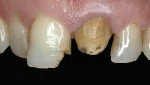 Cerámica sin metal Procera