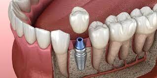 Mejora de osteointegracion del implante