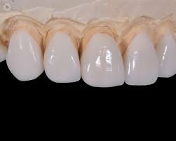 El francés Nicolas Dubois de Chemant recibe la primera patente de dientes de porcelana.