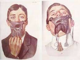 Sanford C. Barnum desarrolla la presa de goma, un pedazo de caucho elástico montado sobre un diente por medio de pesos.