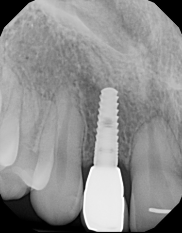 Linkow crea el implante dental Ventplant