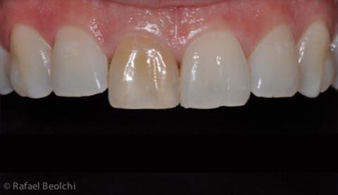 Resina compuesta directa.