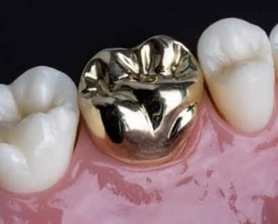 Primer sistema de coronas de metal