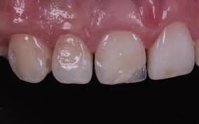 Utilización de composites o resinas compuestas. - Ray Bowen