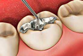 Amalgama Dr. Wiliam Youdelis