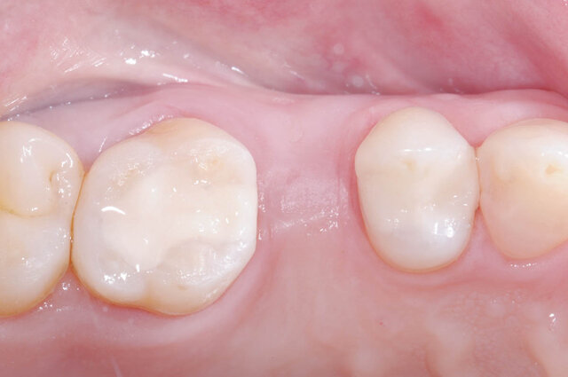 Introducción del hibrido de ionómero de vidrio y resina