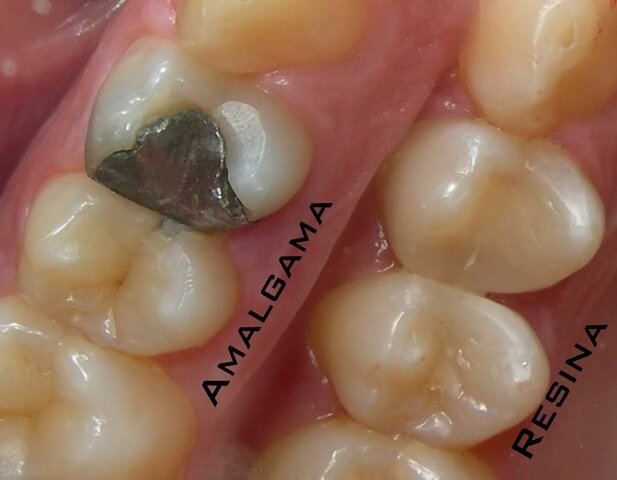Recomendación sobre amalgamas.