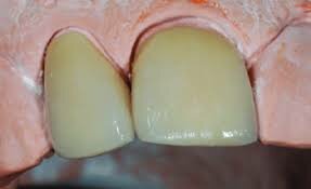 Introducción IN-CERAM ALUMINA