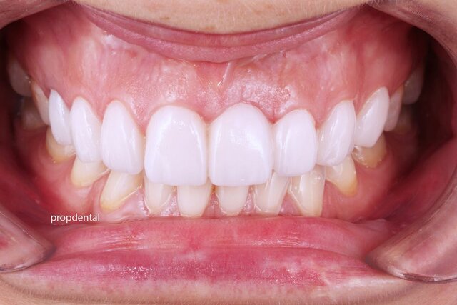 Dientes de porcelana