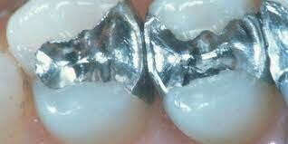 Amalgama dental