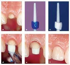 Fue descrito por primera vez un poste de zirconio 28,29 . Se trata de un material formado por cristales tetragonales de zirconio estabilizados con óxido de itrio