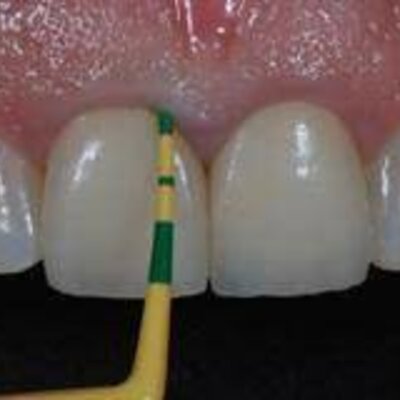 Timeline: Avances en la Odontologia Restauradora