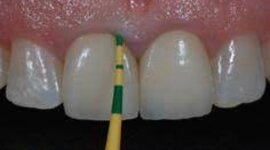 Timeline: Avances en la Odontologia Restauradora