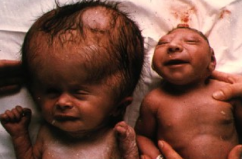 Nacimientos de niños con malformaciones por el medicamento talidomida. Europa, Australia, Canadá, Japón.