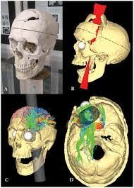 Phineas Gage y el enigma del córtex prefrontal