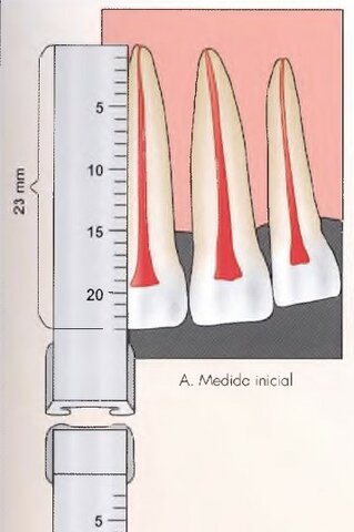 LONGITUD RADICULAR Y OBTURACION