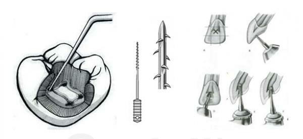 1° INSTRUMENTO ENDODÓNTICO
