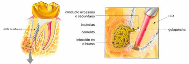 PRESENCIA BACTERIANA EN CONDUCTO