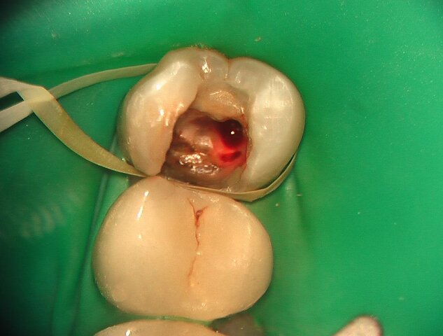 DESINFECTANTE EN DIENTES DESPULPADOS