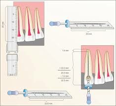 LONGITUD RADICULAR Y NIVEL DE OBTURACIÓN