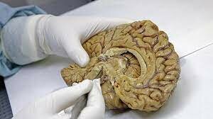 Tejido cerebral