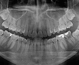 Rayos x para odontología