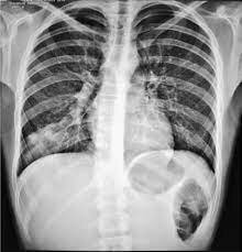 Aparece en china la neumonía atípica enfermedad respiratoria producida por un coronavirus.