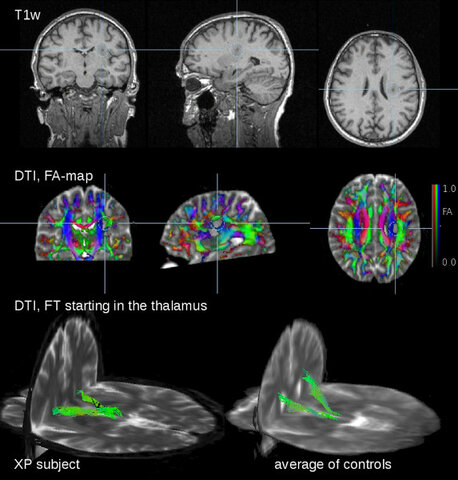 Se introduce  la neuroimagen por tensor de difusión que permite visualizar el recorrido de las fibras  nerviosas.