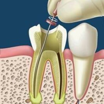 Timeline: HISTORIA DE LA ENDODONCIA