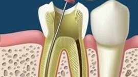 Timeline: HISTORIA DE LA ENDODONCIA