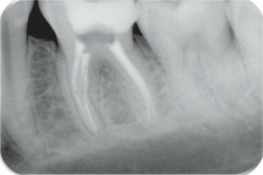 RADIOGRAFÍAS PARA LOS CONDUCTOS RADICULARES