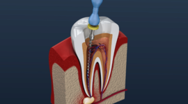 Timeline: Endodoncia
