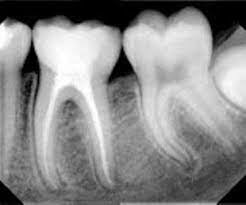(1928-1936) ÉPOCA DEL RESURGIMIENTO ENDODÓNTICO
