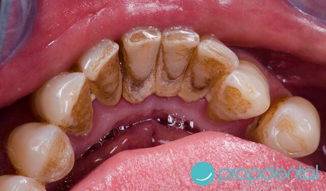 PLACA DENTOBACTERIANA