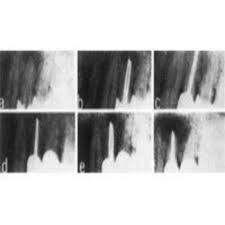 Época del resurgimiento endodóntico