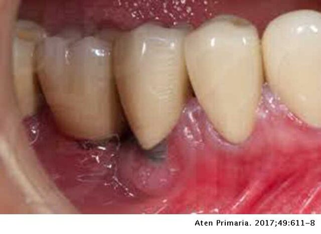 Época de la concresión o afirmación de la endodoncia