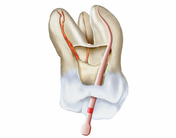 Endodoncia contemporanea o tecnológica