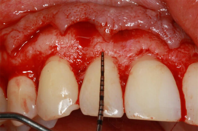 Avances clave en la periodontitis