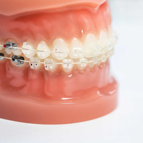 Surgieron distintos tipos de brackets, como la ortodoncia transparente invisalign