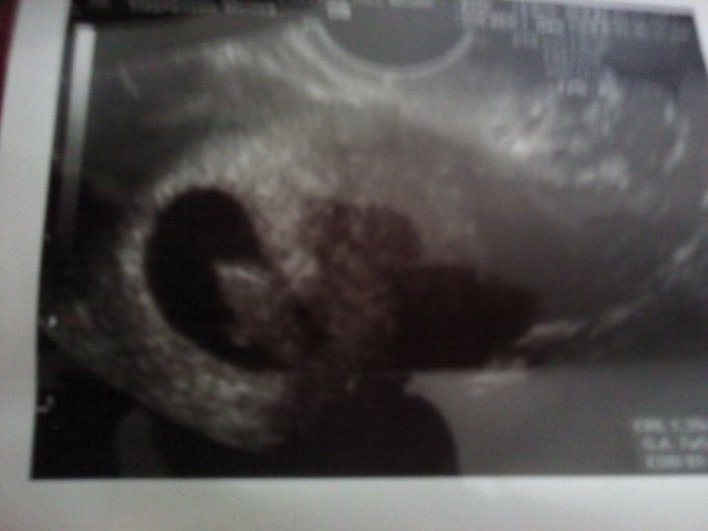 7 Weeks  5 Days Along