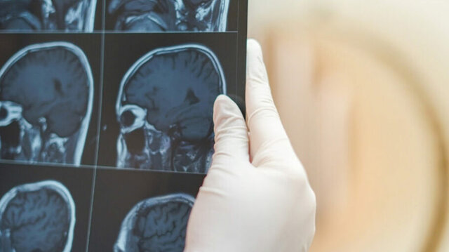 Resonancia magnética funcional