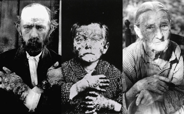 Descripción de la pelagra