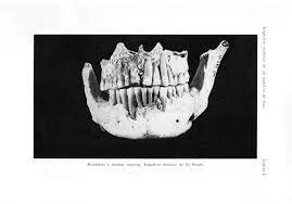 Primer acto quirúrgico "Avulsión dentaria"