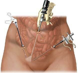 PRIMERA COLECISTOMIA POR VIA LAPAROSCOPICA